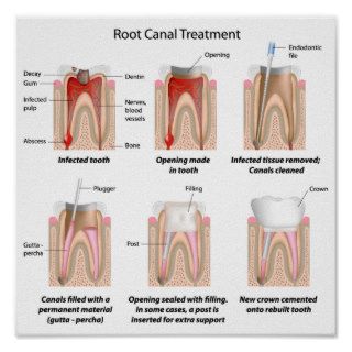 Root canal treatment Poster
